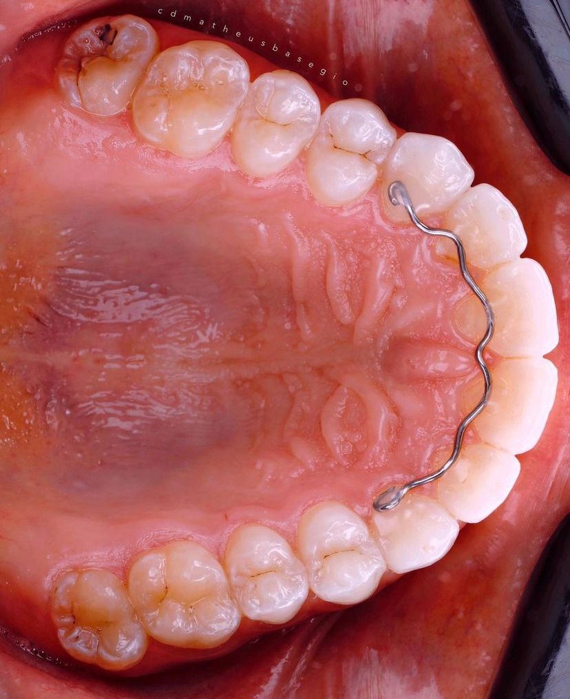 KIT 8- CÂMERA PROFISSIONAL R100 MIRRORLESS + LENTE MACRO CANON 85MM OU RF 100MM +  FLASH CIRCULAR GODOX MF-R76 ( GARANTIA DE FÁBRICA )