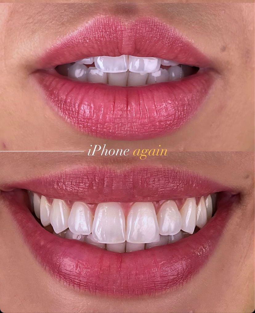 KIT FOTOGRÁFICO PARA SMARTPHONE/FILMAGEM P/ CONSUTÓRIO + QUADRO ESTABILIZADOR + SUPORTE P/MÃO